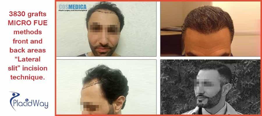 Before and After Images of FUE Procedure in Istanbul, Turkey
